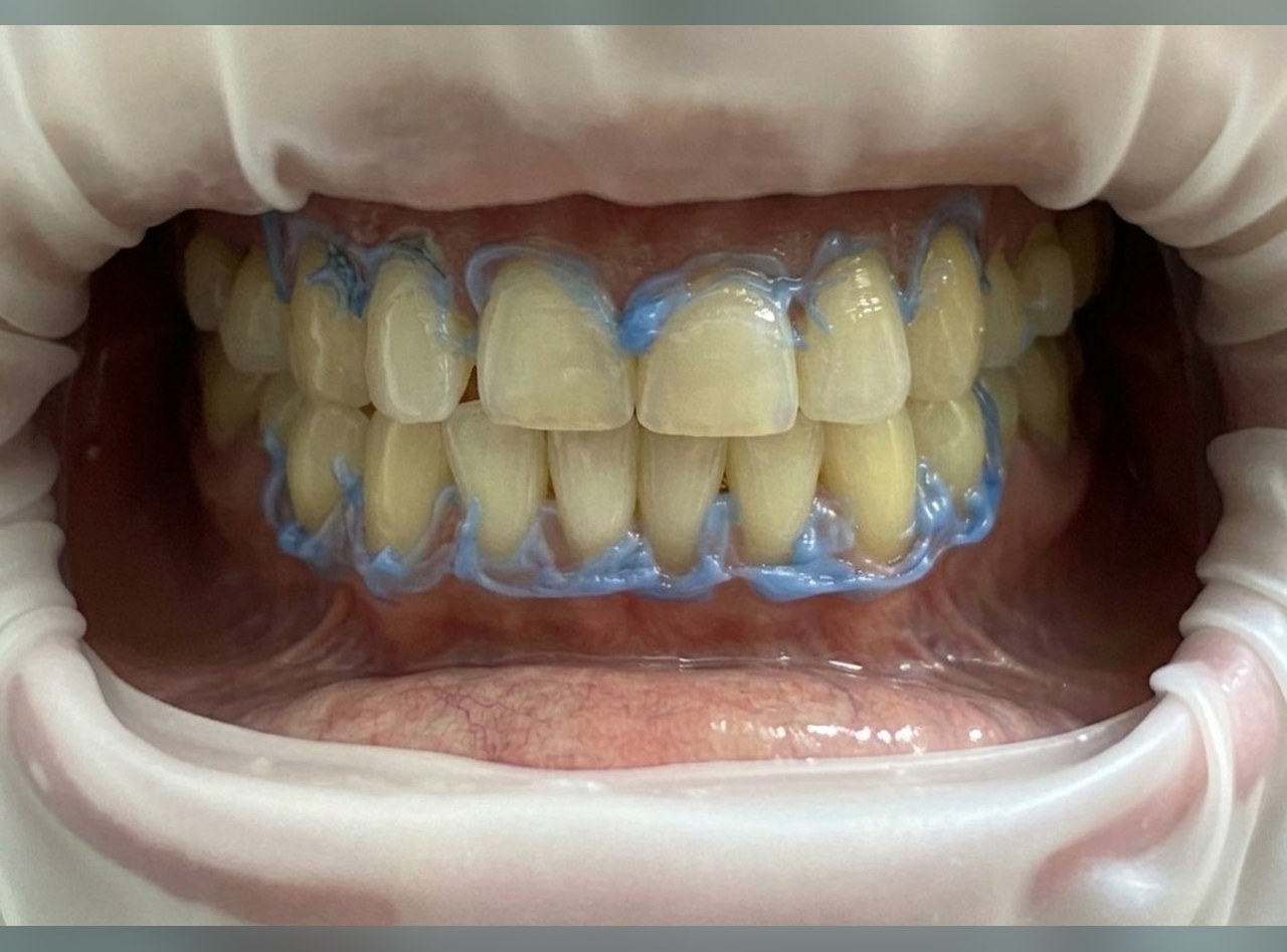 Dientes amarillentos durante la sesión, con la barrera azul protegiendo la encía