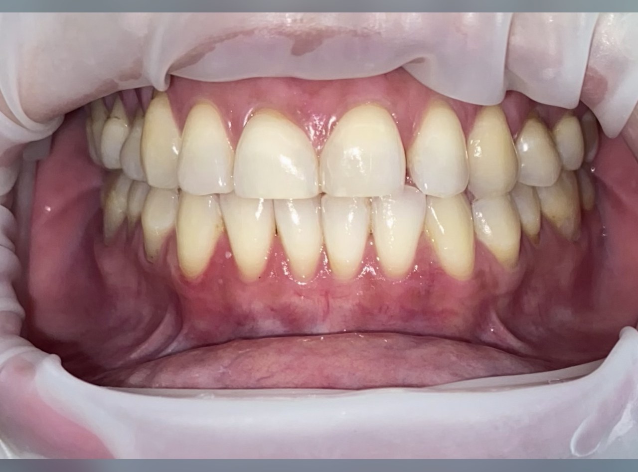 Los mismos dientes al terminar, varios tonos más claros