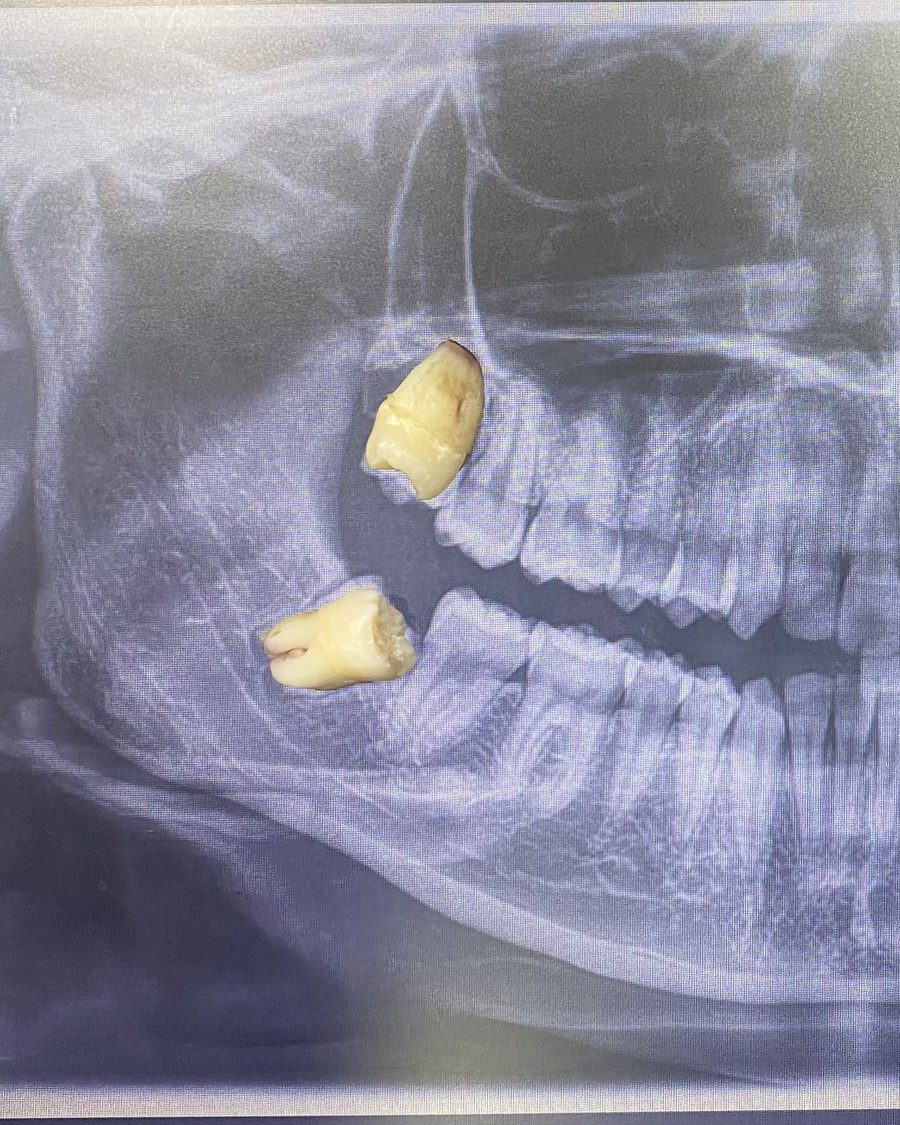 Dos cordales extraídas colocadas sobre la radiografía panorámica, en el lugar de donde salieron