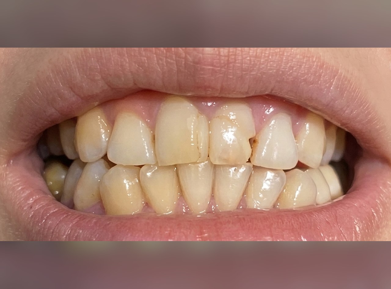Dientes de arriba desgastados y desparejos antes de las coronas