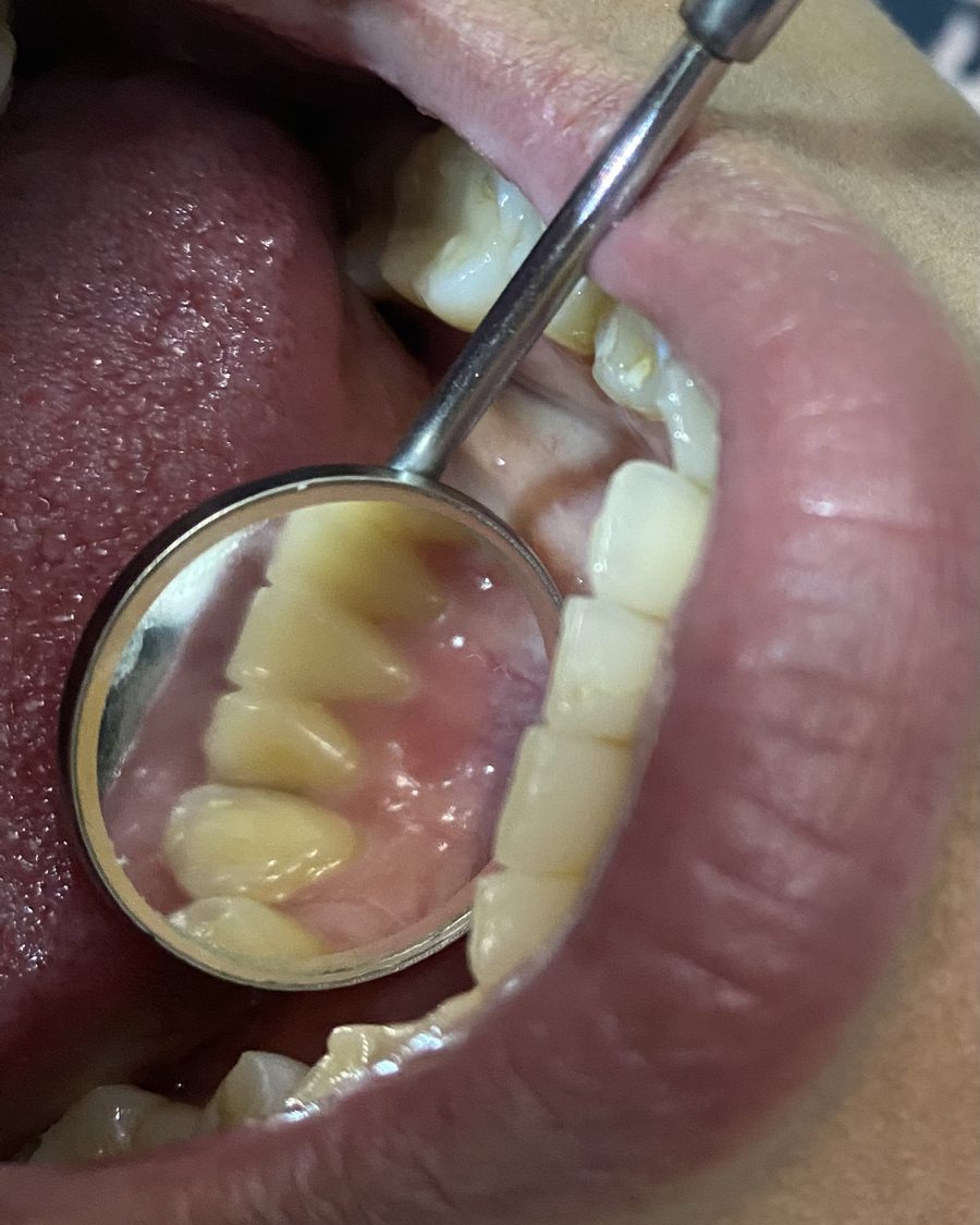 Dientes inferiores vistos con espejo dental tras una limpieza de rutina