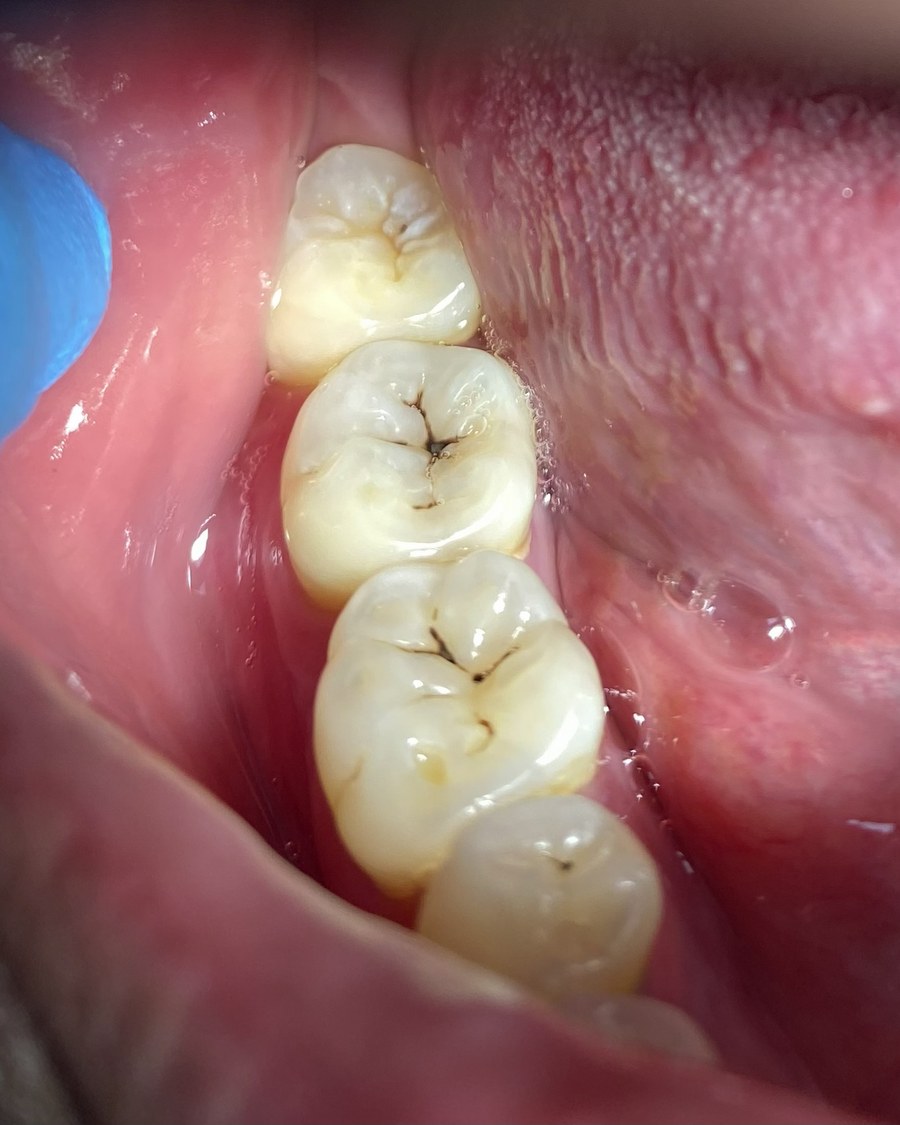 Molares con caries oscureciendo los surcos, antes del tratamiento