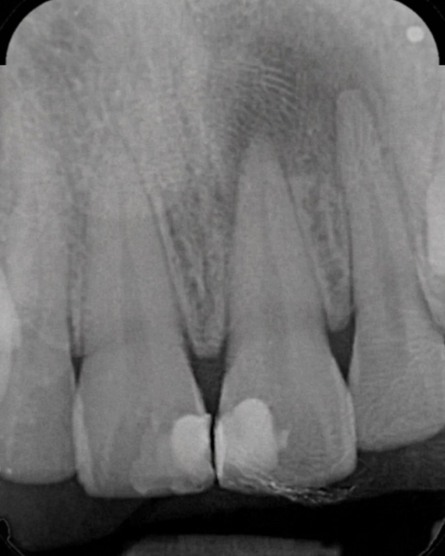 Radiografía periapical de dos incisivos superiores con una lesión en la raíz
